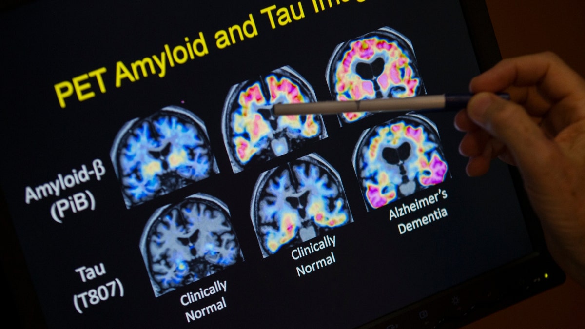 Alzheimer’s disease on mother’s side of the family could increase inherited risk, study finds