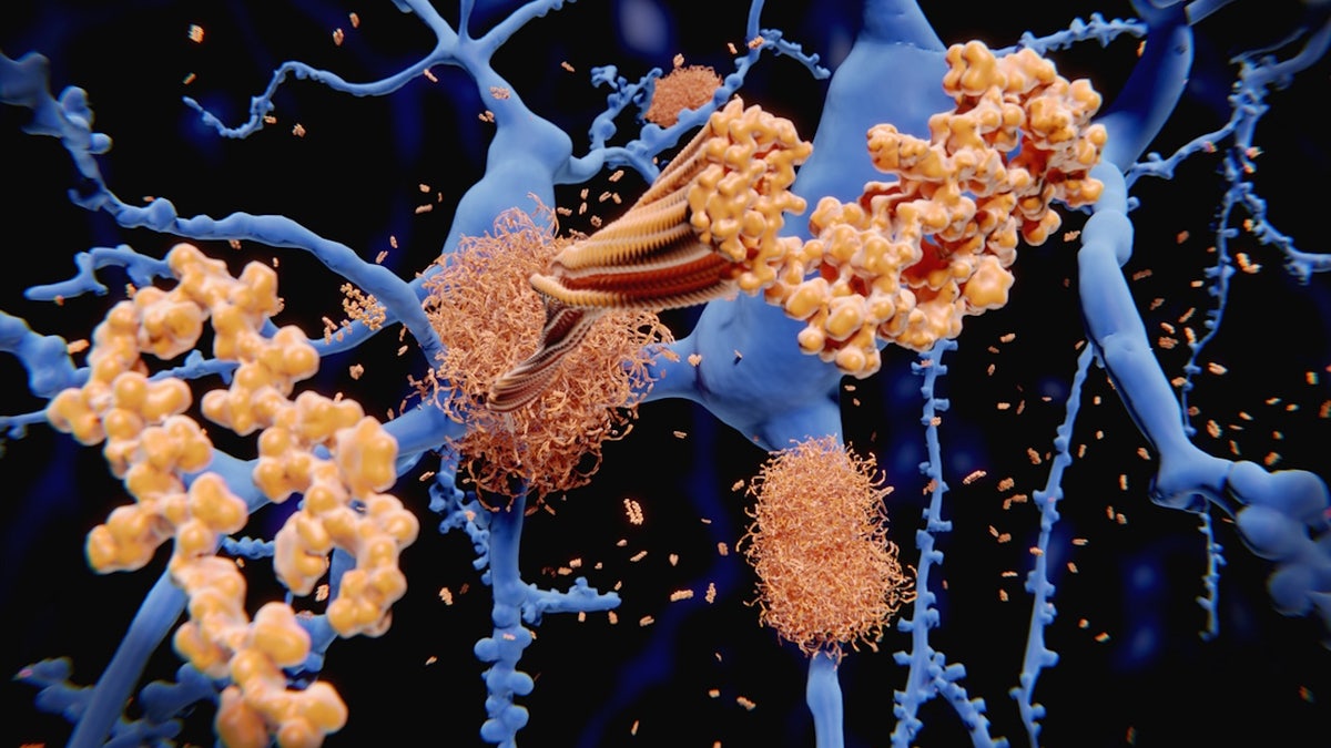 Alzheimer’s disease on mother’s side of the family could increase inherited risk, study finds